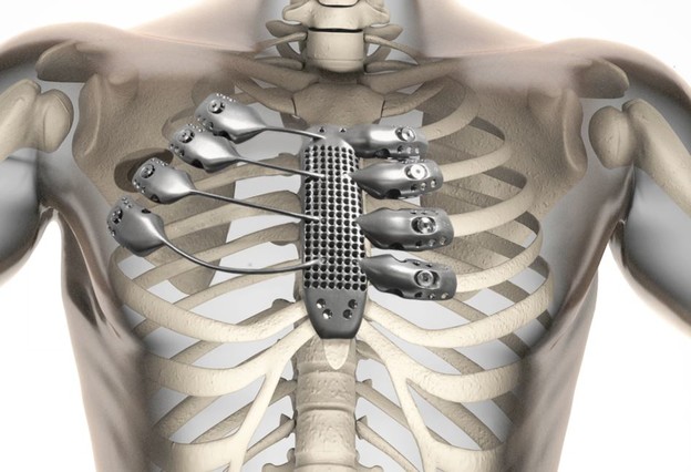 VIDEO: U pacijenta ugrađena prva 3D printana rebra VIDEO: U pacijenta ugrađena prva 3D printana rebra